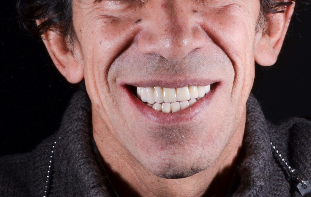 denti dopo trattamento protesi dentali busto arsizio