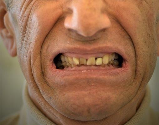 denti prima del trattamento di rigenerazione
